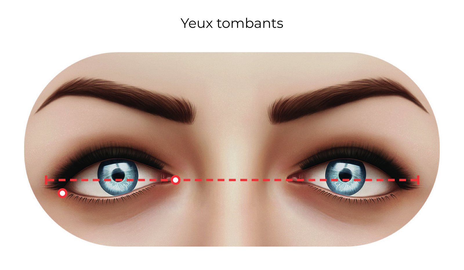 Yeux tombants